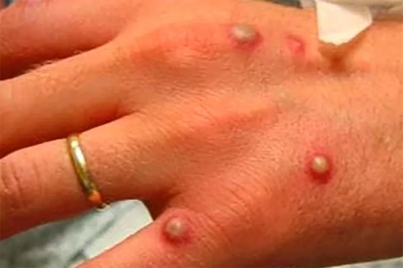 Viruela símica en Chile: Especialistas abordan alza sostenida de contagios